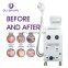 Trending products Medical CE Approved arrivals ipl permanent hair removal machine