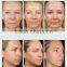 AYJ-C19(CE) Dot matrix portable thermal rf beauty equipment fractionel
