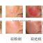 Effective treatment result professional laser scar removal equipment