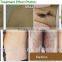 high quality 810nm diode laser medical 808laser hair removal/hair removal speed 808/fast easy hair removal laser