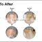ND-YAG laser machine for tattoo removal amd SHR fast hair removal machine