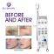 Professional ipl machine hair removal machine with 6 filters shr ipl opt / OPT SHR IPL for hair removal