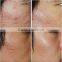 Portable fractional rf microneedle Wrinkle Removal machine/rf fractional micro needle / rf machine  china