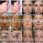 Seven tips HFU For Skin Tighten , Skin resurfacing and promote the skin