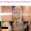 2015 Best selling no pain remove tattoos Q switch nd-yag laser machine