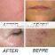 Tattoo Removal Laser Machine Best Effective Laser Tattoo Removal Machine Q Facial Veins Treatment Switch Nd Yag Laser With Spot Size Adjustable