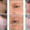 Pain-Free Professional Dual System Permanent Hair Removal/ipl Bode Shr Skin Rejuvenation Tightening Wrinkle Removal/SHR Diode Laser