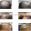 distributor wanted hair loss therapy laser machine with hair analyzer