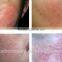 high quality 980nm permanent vein stopper laser machine 980nm diode laser spider vein laser removal machine