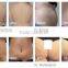 slimming machine body shaping non-invasive body contouring devices/ Radiofrequency