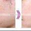 Professional 2016 Professional High Quality Fine Lines Removal Hair Removal IPL+RF E-LIGHT Machine