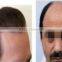 hair regrowth Machine Low Level Laser laser Hair Regrowth Machine!!Medical Beauty Machine! !