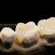 Dental crown e.Max ceramic, porcelain crown, dental veneers, laboratoire dentaire, Dentallabor, laboratorio dental, dental laboratory, Shenzhen LJ dental lab China