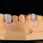 Denture false teeth CAD/CAM Design dental laboratory dental restorations dental Implant Restorations