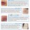 freckles removal pen ,plasma pen,spot pen remover ,face black spot remover,freckle spots remove pen,dark spot remover