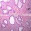 Individual slides you can choose from Educational human tissue pathology of Cancer lymph node metastasis prepared slides
