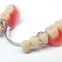 dental laboratory false teeth Chrome Cobalt titanium 3d metal printed partial dentures