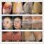 Professional Elight Ipl Rf Mongolian Spots Removal Nd Yag Laser Machine 1064nm