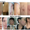 Factory CO2 Fractional Laser Machine Stretch Mark Removal Acne Scar Removal Machine Skin Resurfacing Machine