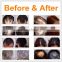Professional hair regrowth treatment