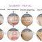portable style ipl with impulse light treatment hair removal