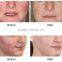 Professional oxygen sprayer and jet peel skin rejuvenation beauty salon equipment (with CE) for acne remove