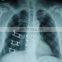 Sternum Fracture TiNi SMA Fixater Type II