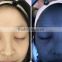 Magic mirror 3d facial skin acne analyzer/ skin moisture analysis equipment