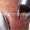Professional portable 980nm diode laser vascular removal/ rbs spider vein removal machine/vascular laser 980 nm