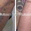 Q-Switch Nd Yag Laser Tattoo Removal System/Q Switched Laser For Tattoo Removal