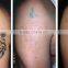 hottest nd yag laser treatment medical device for birthmark removal