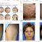 Professional Clinic / Beauty Spa / Salon Use Fast Hair Removal SHR IPL