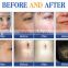 3 in 1 Microneedle Skin Set Therapy Derma Roller 180/600/1200 Needles Anti Agingcal