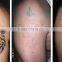 1064nm 532nm Q Switch Nd Yag Laser Tattoo 1-10Hz Removal Machine With Factory Price Pigmented Lesions Treatment