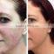 YUWEI Medical Electronic Pulse Face Eye Wrinkle Removal Eye Care Massage