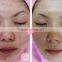 Effectively mini dermabrasion Systerm/skin care face cleaning diamond dermabrasion