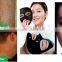 Freckles Removal Most Popular ND YAG Facial Veins Treatment Laser Price Tattoo Removal Laser Machine