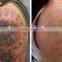 Q-switch Laser Tattoo Removal Yag Laser Hori Naevus Removal 1064nm & 532nm Ota Nevus Machine Pigmented Lesions Treatment