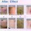 Fractional Rf tube Co2 Laser / Vagina Tighten/acne wrinkle removal