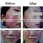 Skin rejuvenation facial spider vein laser machine