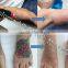 Beautician use Nd Yag Laser tattoo removal laser for sale