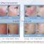 980nm laser vascular removal,physical therapy, onychomycosis treatment