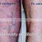 Distributor in Iraq 980nm medical diode laser spider veins removal machine