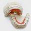 Metal Free Dental Inlays And Onlays With Biocompatibility, Corrosion Resistance