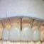 Safety Corrosion Resistant OEM Porcelain Crown All Ceramic Natural Look