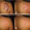 Q Switch Nd Yag Laser Tattoo Removal Facial Veins Treatment Machine /q Switch Nd Yag Active Laser Pigmented Lesions Treatment