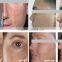 2015 HOT selling Apolomed 2940nm HS-820 acne scar removal laser scar removal