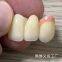 Dental Lab Mk1 Precision Attached Dentures Are Beautiful And Natural