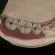 Dental-Implants china outsourcing dental lab