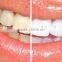 Dental Teeth Whitening Gel Strips Tooth Whitening kits